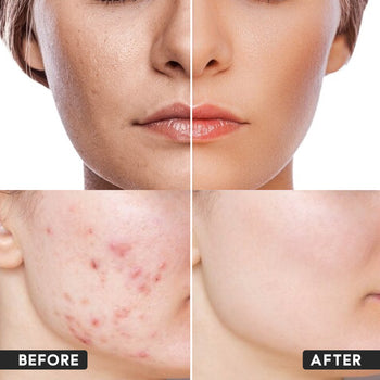 Anti Acne gel With Moisturizer
