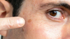 Age Spots
