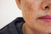 Hyperpigmentation