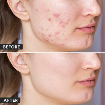 ಮೊಡವೆ ವಿರೋಧಿ ಜೆಲ್...