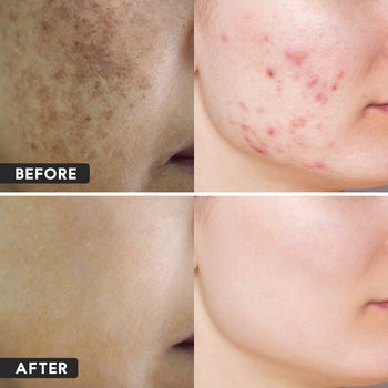 07- ಆಂಟಿ ಮೊಡವೆ ಜೆಲ್ (30 ಗ್ರಾಂ) + ಅವರಂಪೂ ಸೋಪ್ (120 ಗ್ರಾಂ)...