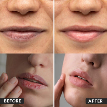 Lip Care Kit For Dark Lips