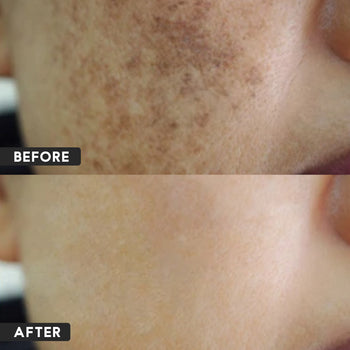 Anti Melasma With Goat Milk Soap