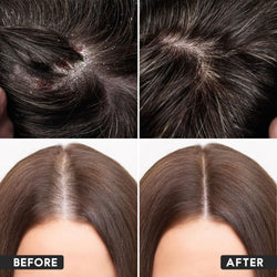 Rosemary Dandruff Defense